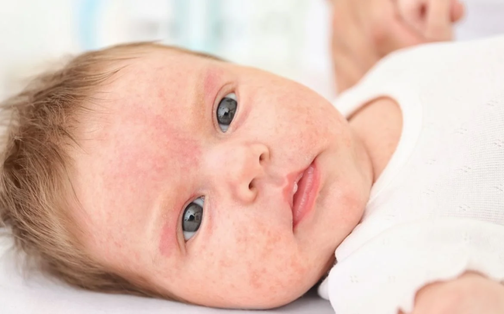 Alergia do calor em bebês